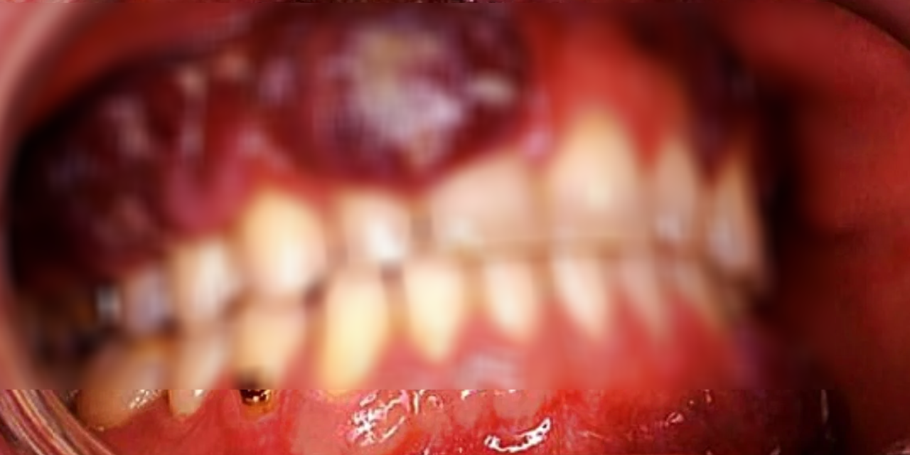 මුඛ පිළිකාවලින් දිනකට තිදෙනෙක් මිය යනවා